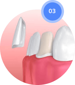 Veneer Placement